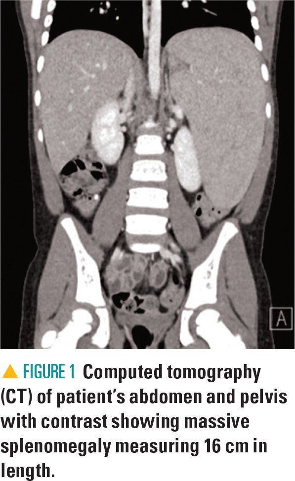 A CT scan of the patient's abdomen and pelvis with contrast showing massive splenomegaly measuring 16 cm in length
