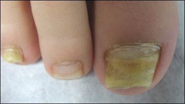 Tips for Identifying and Treating Nail Disorders