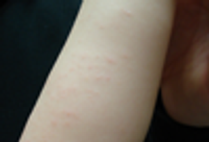 A 3-Year Old Girl with a Rash on Left Arm, Flank, and Thigh