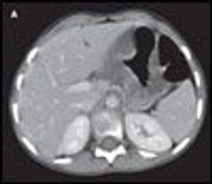 Henoch-Schönlein purpura with gastric wall thickening