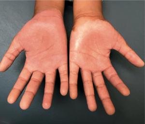 Painful, tense acral bullae in a 12-year-old girl