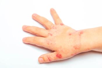 Pooled phase 3 data show early, consistent tapinarof cream responses across pediatric age groups in AD | Image credit: © Ruslan Ivantsov - stock.adobe.com.