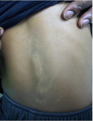 Congenital hypopigmented macules on a healthy child 