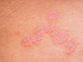 Study: Daily emollient for infants could reduce atopic dermatitis incidence | Image credit: stock.adobe.com.