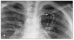 Subclavian Central Venous Catheter Fracture and Embolization