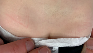 persistent atrophic, fibrotic plaque has been growing on a toddler’s lower back