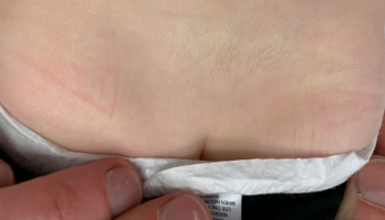 persistent atrophic, fibrotic plaque has been growing on a toddler’s lower back