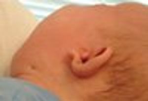 Ear Anomalies and Neck Sinuses in a Newborn