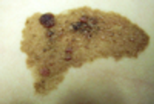 Biologically Active Large Congenital Nevi