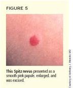 what is spitz melanoma