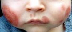 acute hemorrhagic edema of infancy