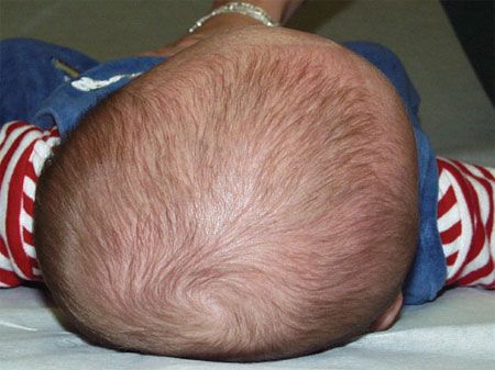لماذا يحدث تسطح مؤخرة رأس الرضيع؟