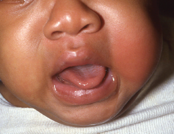 POPSICLE-INDUCED COLD PANNICULITIS (POPSICLE PANNICULITIS)