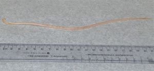 Asymptomatic Girl Who Passes Threadlike Object in Stool