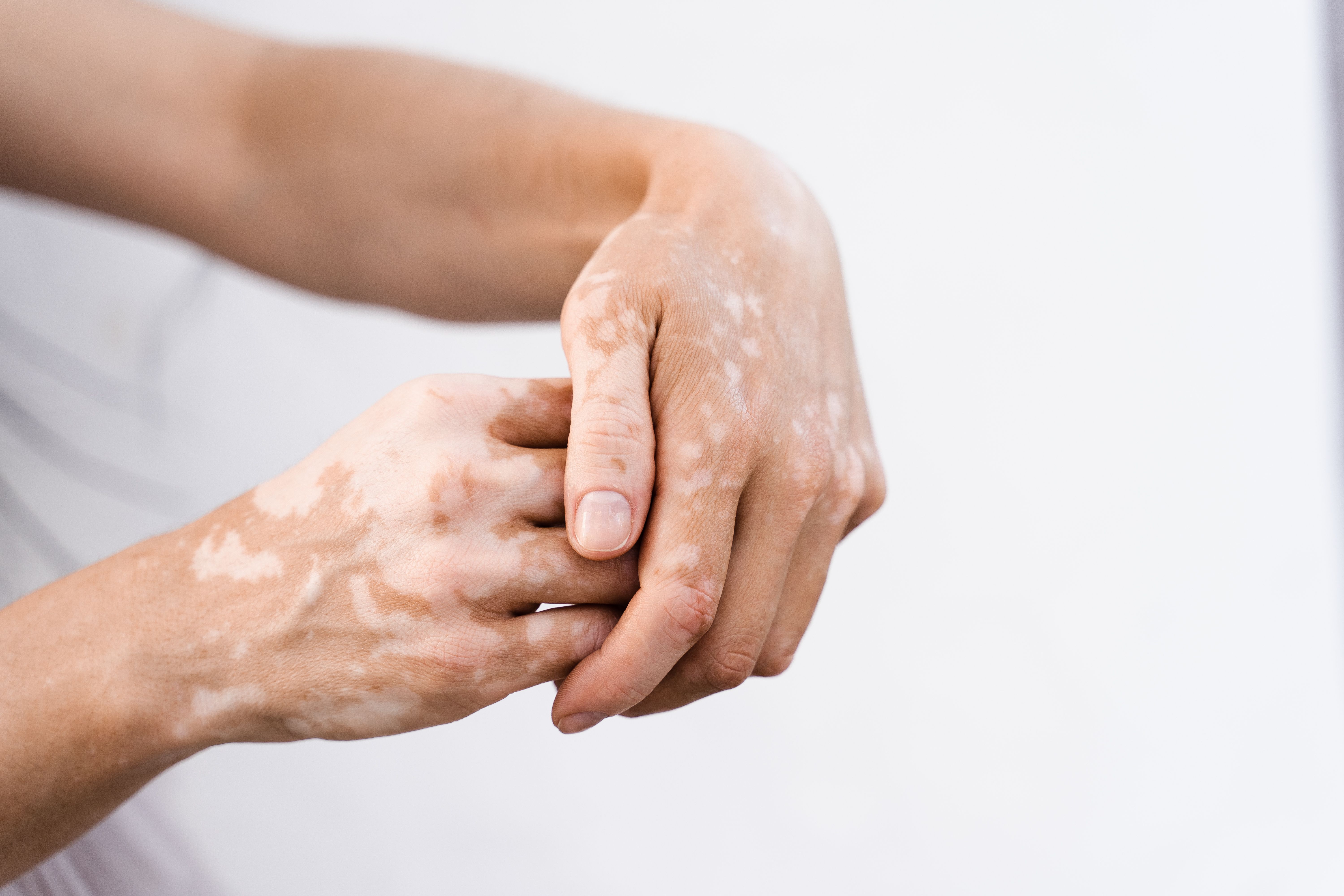 Upadacitinib sustains repigmentation in non-segmental vitiligo through 76 weeks | Image Credit: © Rabizo Anatolii - stock.adobe.com.