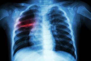 Procalcitonin to diagnose pneumonia in children with influenza-like illness | Image Credit: © stockdevil - © stockdevil - stock.adobe.com.