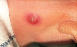 Red papulonodule with central crusting on a neonate’s cheek