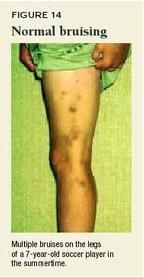 Determining whether a skin injury could be physical abuse Determining whether a skin injury could be physical abuse