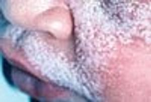 Extensive Miliaria Crystallina