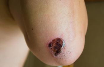 How could NexoBrid change the pediatric thermal burn treatment landscape? | Image Credit: © Paulina - © Paulina - stock.adobe.com.