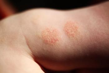 atopic dermatitis