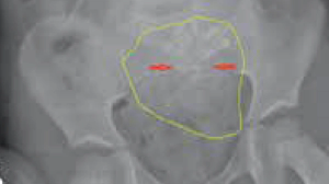 Left lower quadrant abdominal pain, vomiting