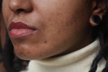 acne in skin of color