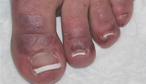 Erythematous-to-violaceous papules and plaques on dorsal toes