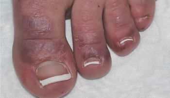 Erythematous-to-violaceous papules and plaques on dorsal toes