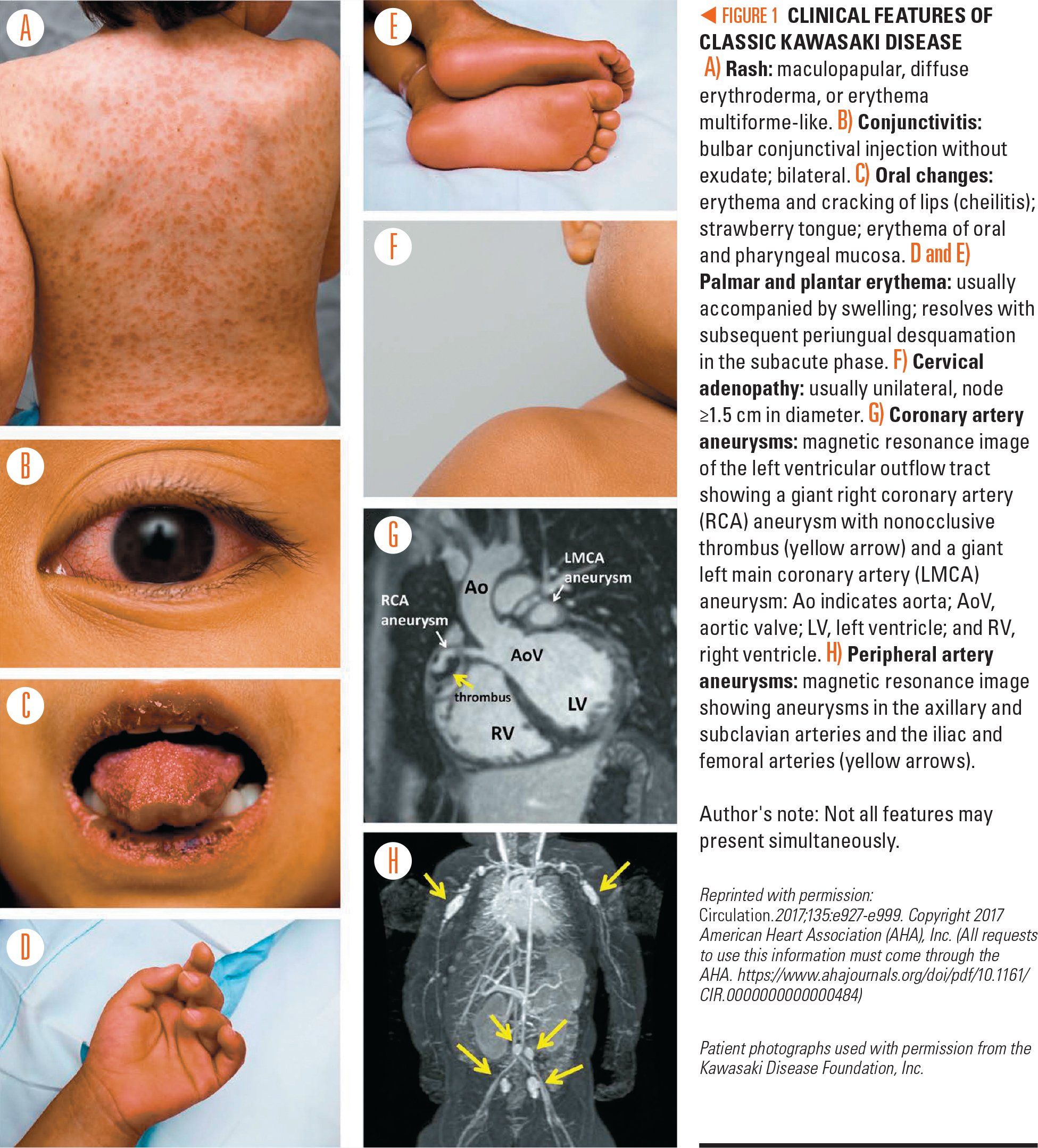 Kawasaki Disease Aha Statement And Recommendations Kawasaki Disease Aha Statement And Recommendations