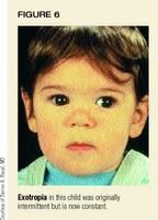 Strabismus Getting It Straight Strabismus Getting It Straight