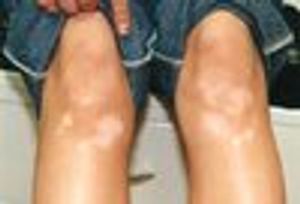 Teen With Progressive Depigmented Patches