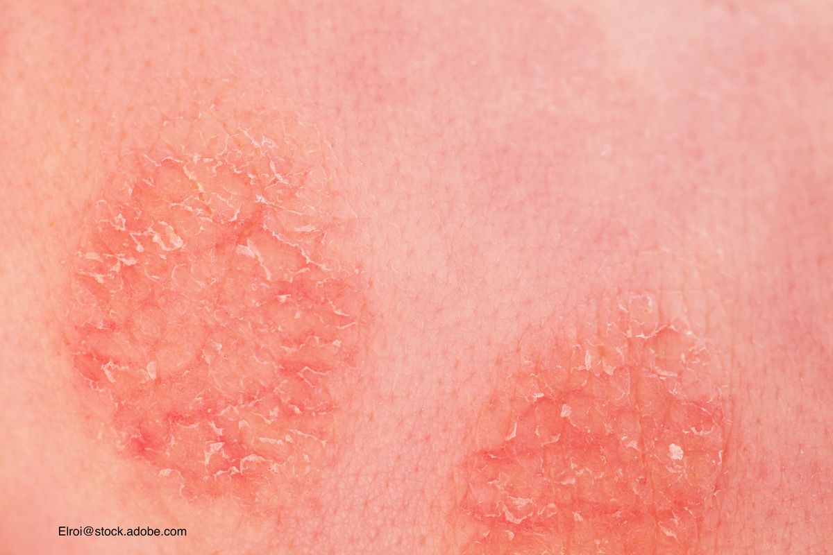 Looking at atopic dermatitis treatment options