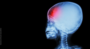 Pediatric migraine: Diagnostic criteria and treatment