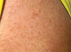 Itchy, Acne-Like Rash on a Boy’s Face and Upper Arms