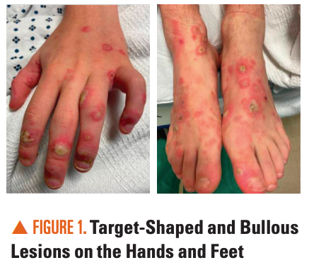 Diffuse Rash Multiple Targetoids Diffuse targetoid and bullous skin lesions, mucositis, and ocular ...