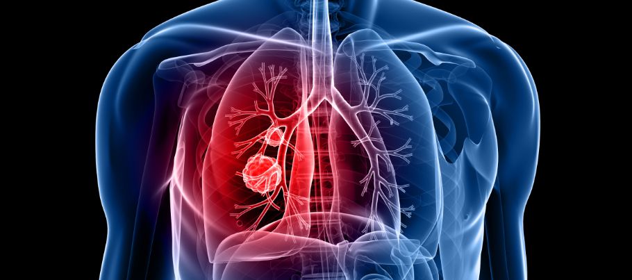 Stage Four Lung Cancer