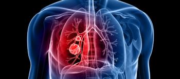 Image of tumors located in the right lung.