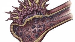 Osteosarcoma Guide: Stages, Treatment, Side Effects and Patient Journey