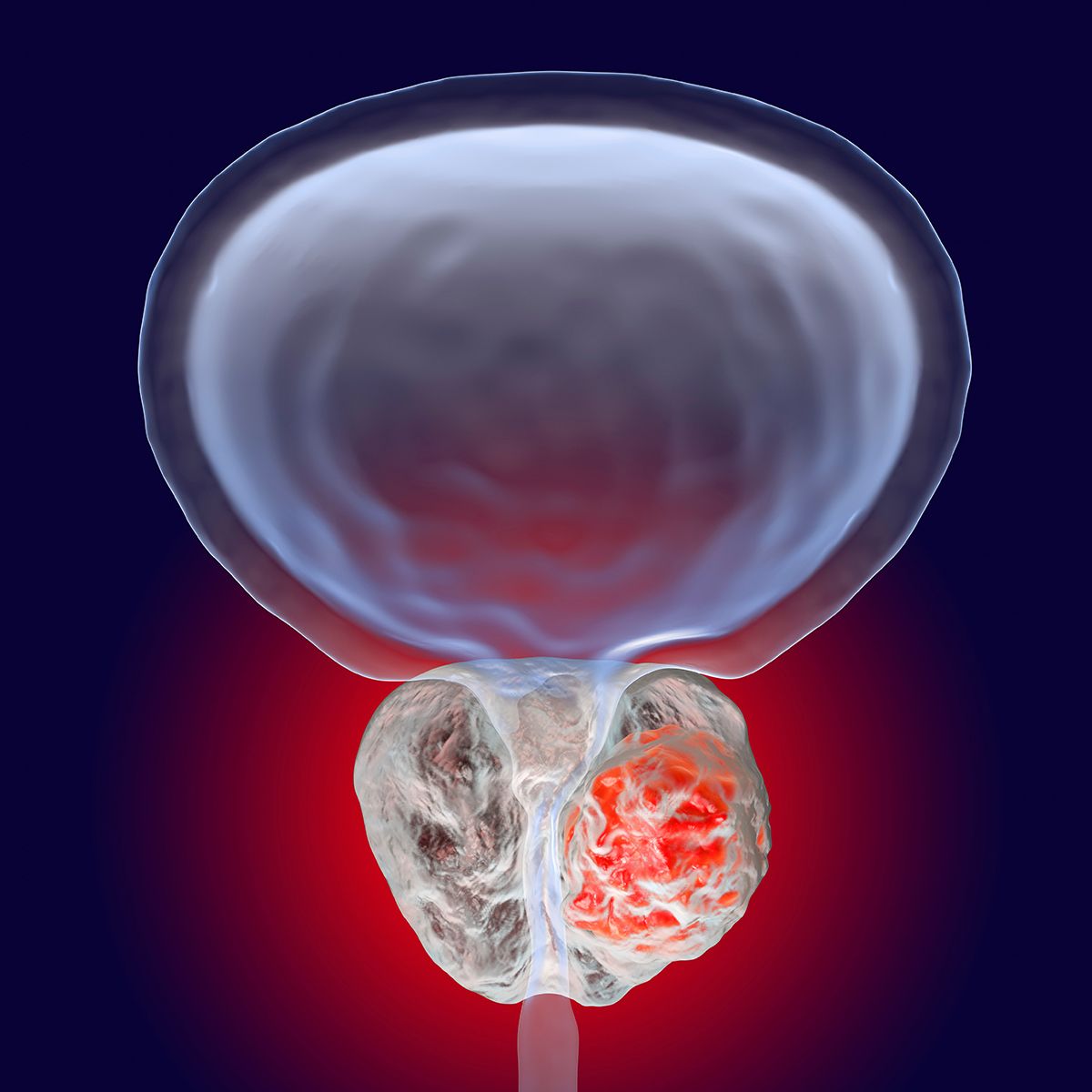 Carotuximab plus Erleada proved safe in a metastatic castration-resistant prostate cancer phase 2 trial: © stock.adobe.com.