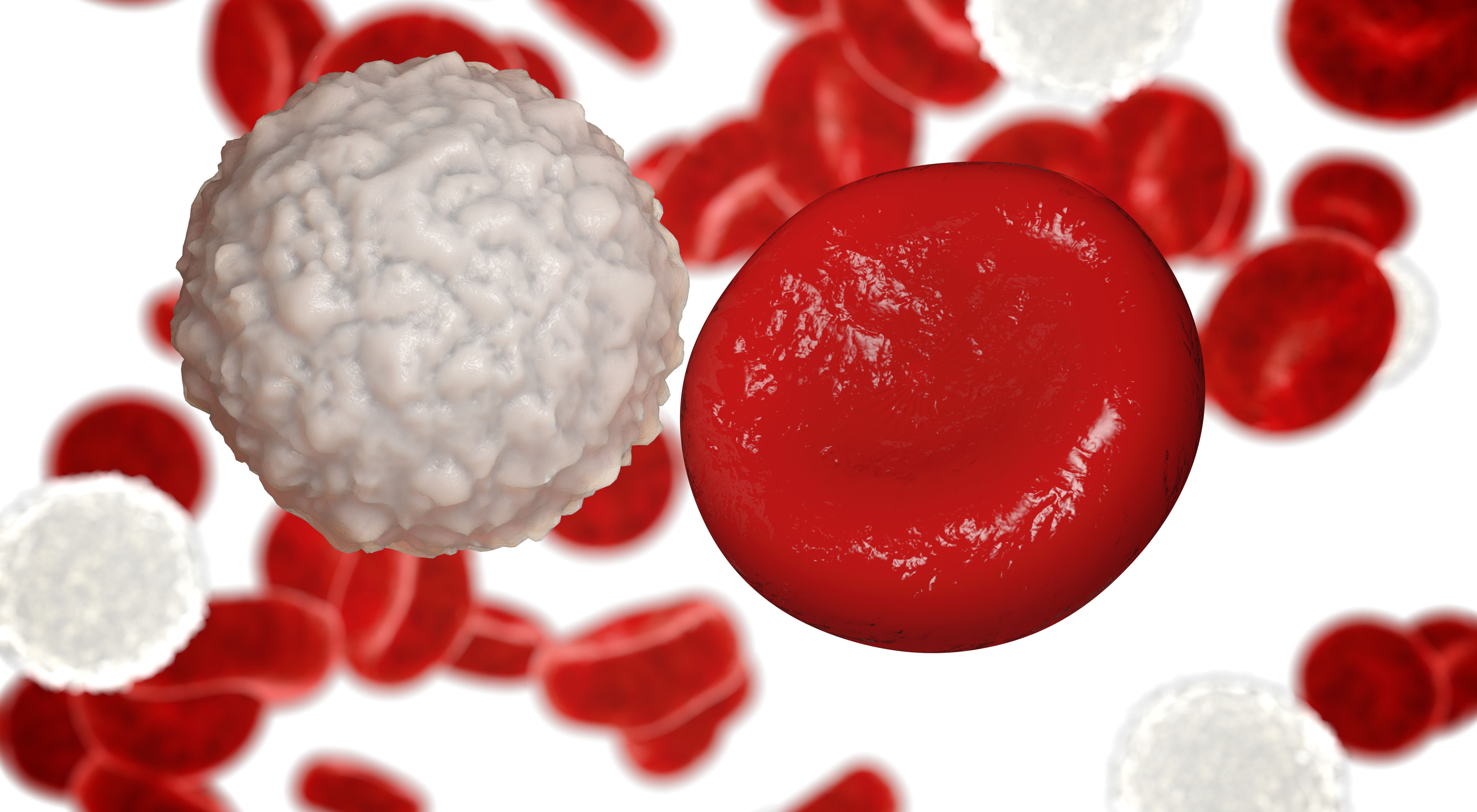 Хронические заболевания крови. Постгеморрагическая анемия гипохромная. Лейкоциты это белые кровяные клетки. Железодефицитная анемия дефицитная лейкоциты. Анемия клетки крови.