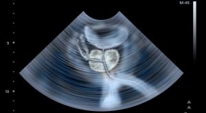 Prostate Cancer Advocacy Groups See Knowledge Gaps Concerning Disease Stages and Related Treatment Options