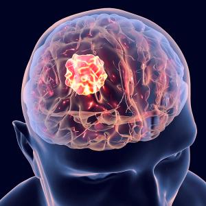CLD-101 treatment showed safety and feasibility in recurrent glioma at multiple intracerebral doses.: © Dr_Microbe - stock.adobe.com