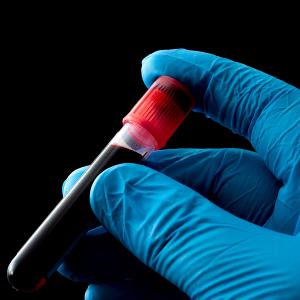 ctDNA-MRD testing better predicted outcomes versus PET/CT scans for large B-cell lymphoma: © vitanovski - stock.adobe.com.