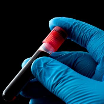 An AI model may help identify patients with myelofibrosis at high risk of early death after transplant, according to an expert: © stock.adobe.com.
