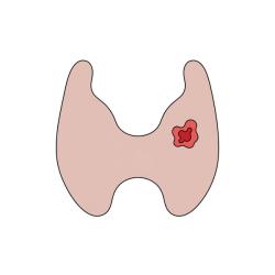 Your Thyroid Cancer Journey: From Diagnosis to Survivorship