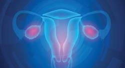 HIPEC May Not Improve Outcomes for Recurrent Epithelial Ovarian Cancer