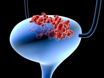 image of bladder cancer