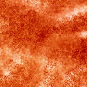 Exciting Advances Are Coming for First-line CML Treatment