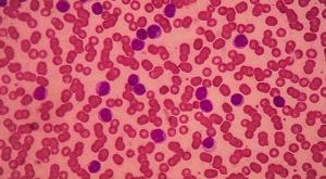 Illustration of CLL cells.